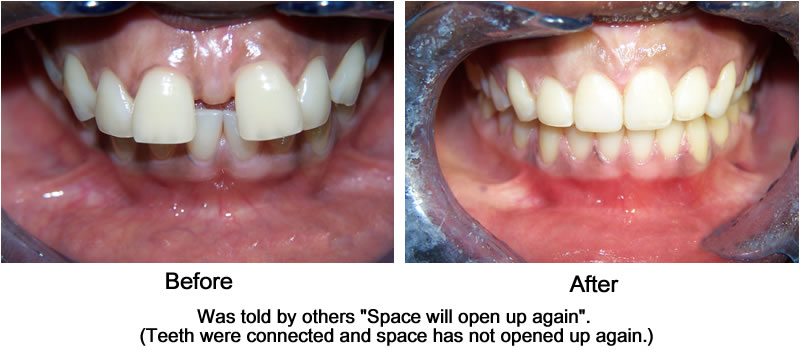 6 Month Braces Before & After 