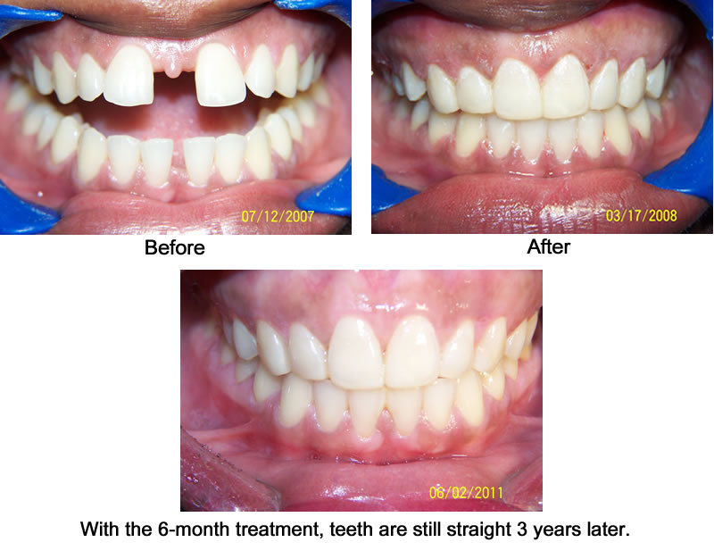 Orthodontic Cases