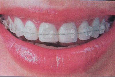 Clear Braces brookline