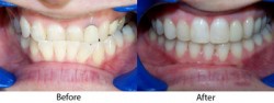 6 months braces schedule