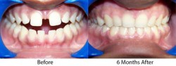 adult cosmetic orthodontics