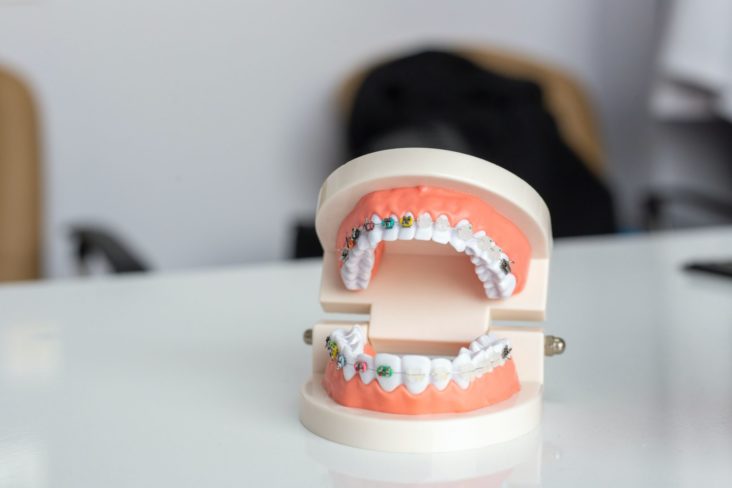 Adult Braces