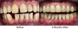 6 month braces before after