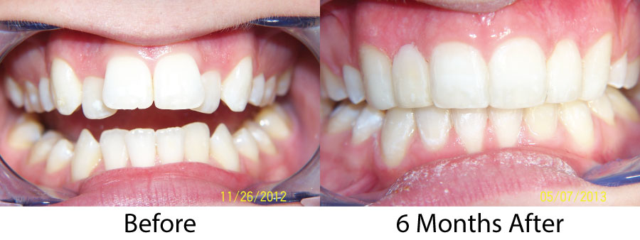 6 Months Braces - Before and After 