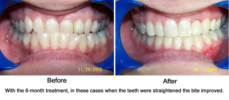 6 Month Braces Before & After 
