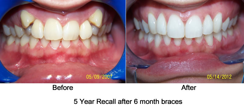 braces recall