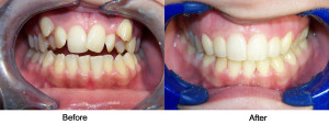 retained baby teeth