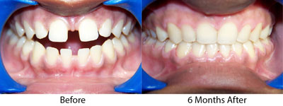 adult cosmetic orthodontics brookline