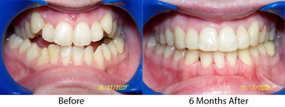 6 month perfect smile brookline