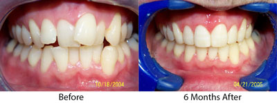 boston 6 month braces treatment