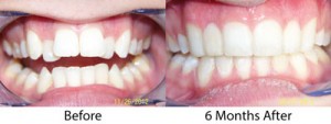 6 month braces