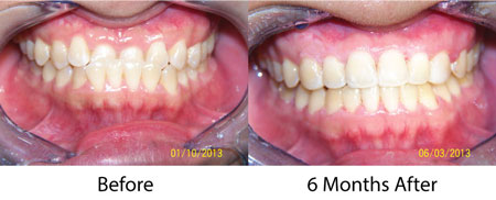 6 month braces result