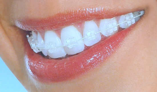 clear braces orthodontic treatment