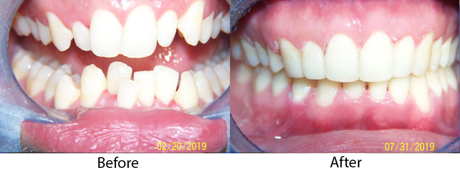 6 Month Braces After & Before