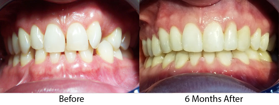adult orthodontics brookline