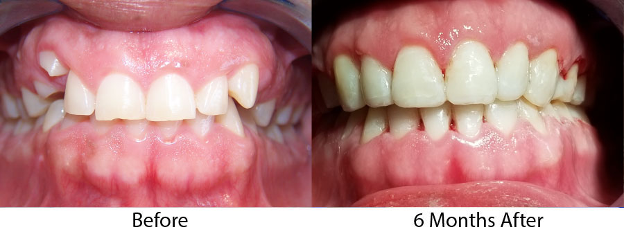 cosmetic orthodontics brookline case