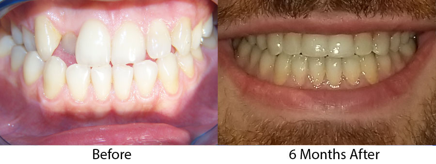 cosmetic orthodontist boston before after