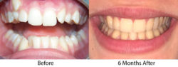 Cosmetic Orthodontics Brookline Before After